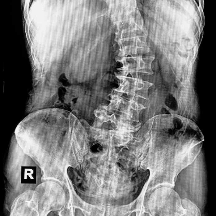 scoliosis chiropractor in Mesa AZ